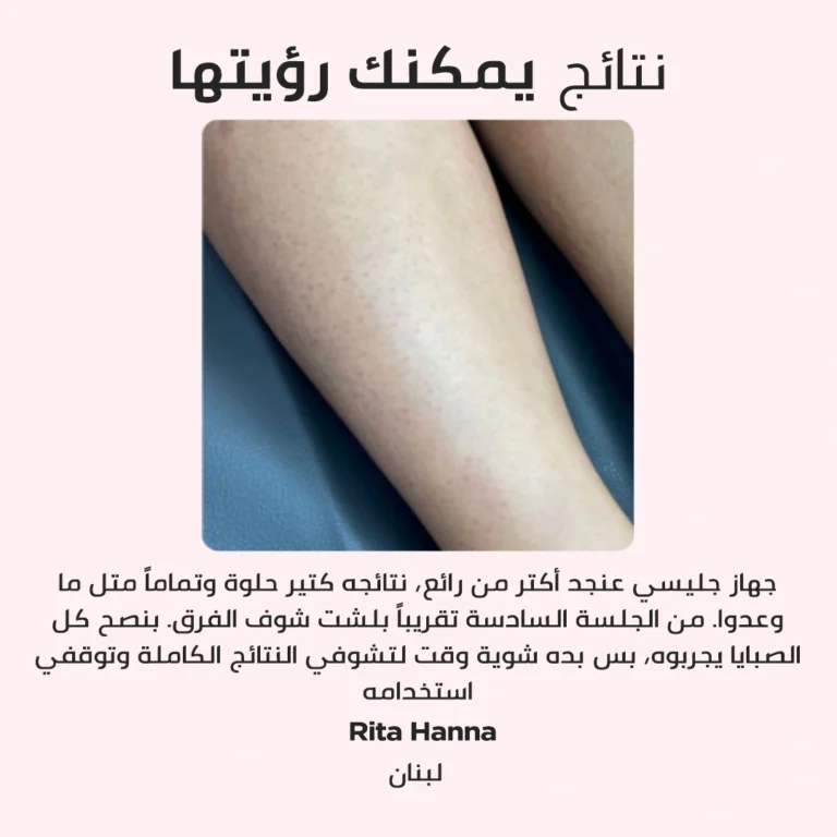نتائج ازالة الشعر غليسي